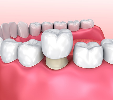 Rendering of a dental crown over abutment tooth with pink background